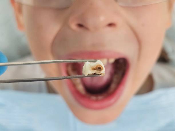 Best Emergency Wisdom Teeth Removal in Summersville, WV